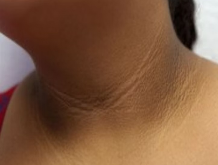  കഴുത്തിലെ കറുപ്പ് നിറം ഇനി ഒരു പ്രശ്നമല്ല! അടുക്കളയിലെ രഹസ്യക്കൂട്ട് ഇതാ!